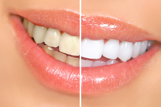 Melyik a legjobb fehérítő fogkrém?