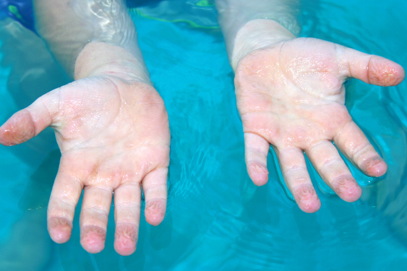 Miért ráncos az ujjad begye, ha sokáig vízben vagy? A tudomány ezzel magyarázza