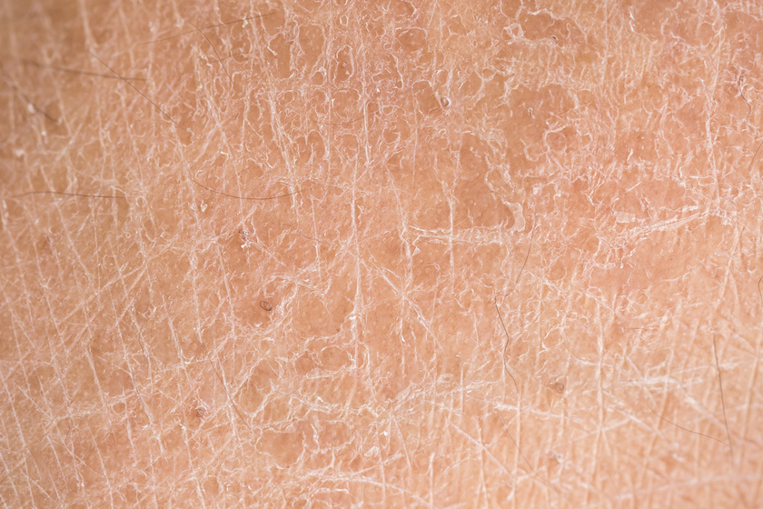 Miért veszélyes a halpikkelyes, extrém száraz bőr? A betegség hátterét sokan nem ismerik