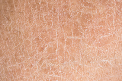 Időskori bőrelváltozások - Okok és kezelési lehetőségek