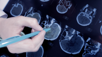 Gyilkos agysejtek megbékítése gyógyíthatja a Parkinson-kórt