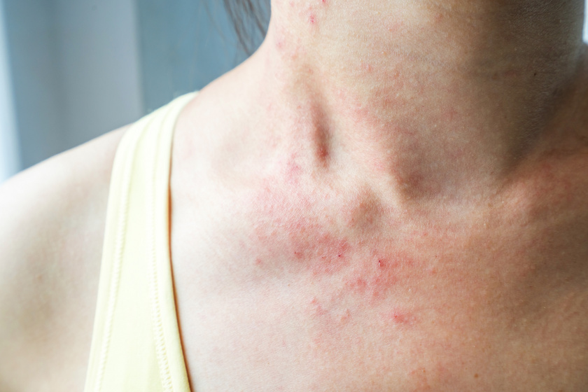 Bőrtünetek, amikkel orvoshoz kell fordulni - A bőrgyógyász szerint baj lehet, ha nem figyelsz rájuk