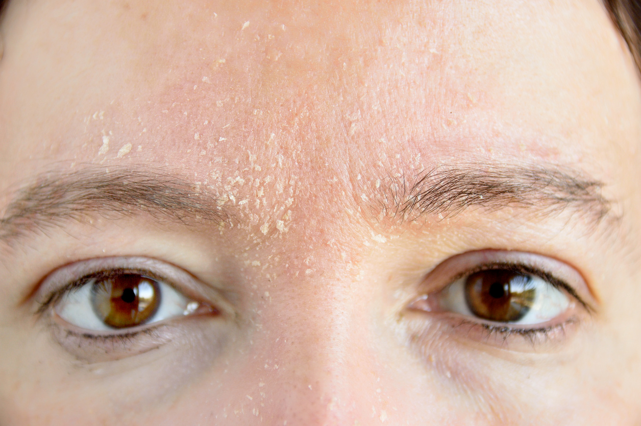 Arcfehérítés. Hogyan lehet hatékonyan és gyorsan fehéríteni az arcbőrt otthon