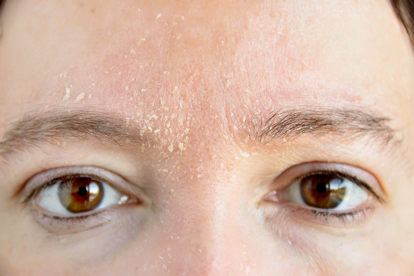 Hámló arcbőr: mi okozza, és mit lehet tenni ellene? A bőrgyógyász mondta el