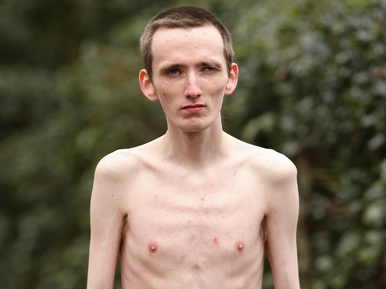 Így néz ki egy anorexiás férfi