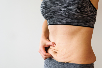 Állítható gyomorszalag, nincs súlyvesztés - Állítható gyomorzsák súlycsökkenés nélkül