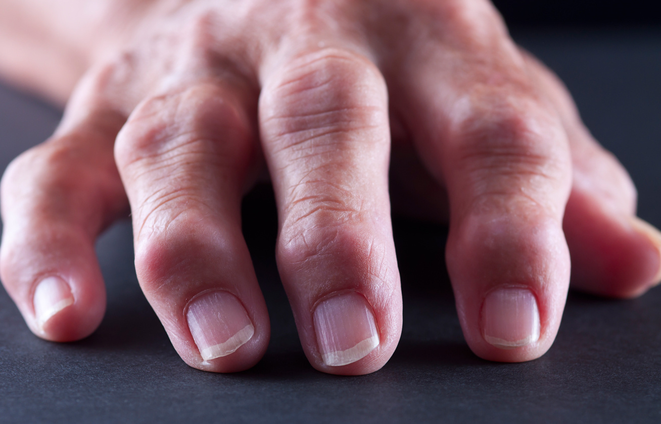 a kezek rheumatoid arthritis tünetei nőkben