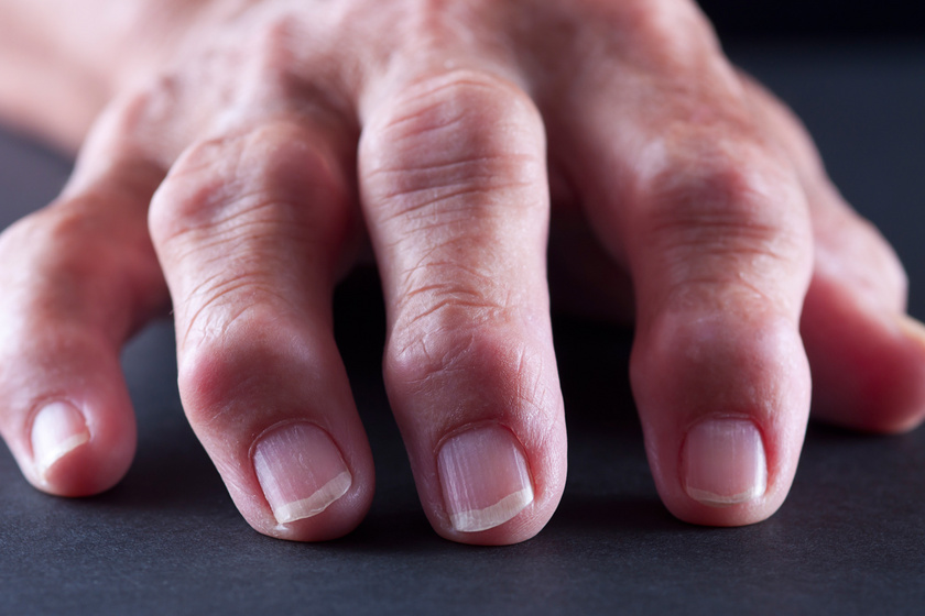 Honnan ismerhető fel a rheumatoid arthritis? Nem csak az ízületeket veszélyezteti