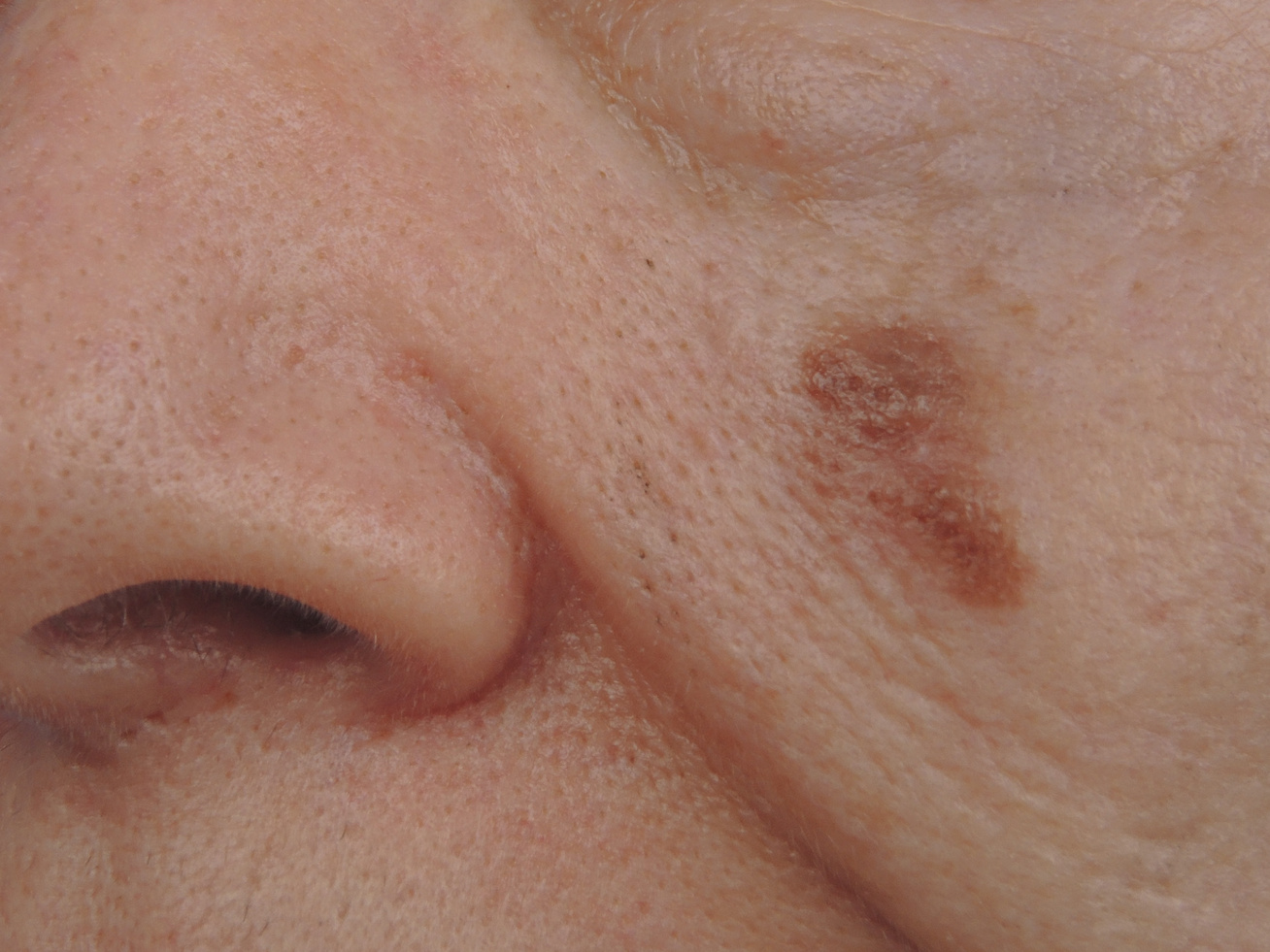 Így ismerheti fel időben a melanoma jeleit, Fertőző bőrrák
