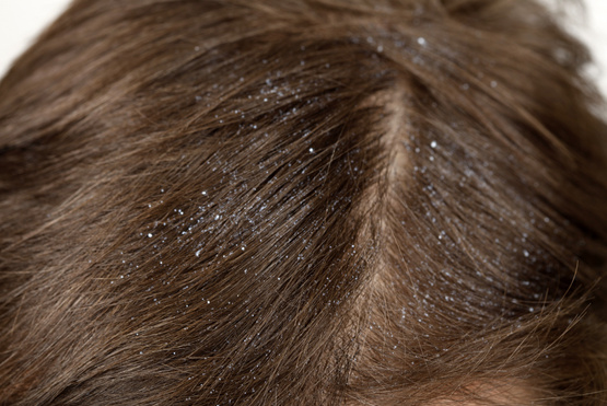 Mitől korpásodik a haj, és mit lehet tenni ellene?