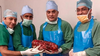 7 kilós vesét operáltak ki egy indiai betegből
