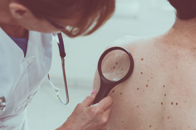Ismered a melanoma 15 rizikófaktorát? A bőrgyógyász elmondja, mire kell figyelni a napozáson túl