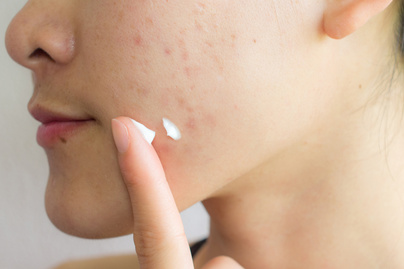 9 összetevő a krémekben, amit kerülj, ha pattanásos a bőröd: a bőrgyógyászok szerint tovább rontanak a helyzeten