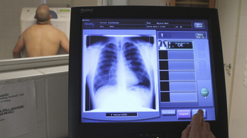 Az EU-ban először Horvátországban indítanak nemzeti tüdőrák-szűrőprogramot