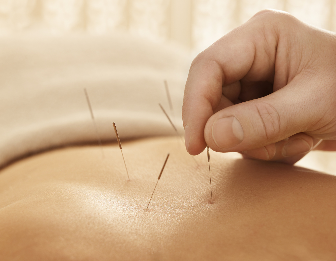 Hogy segíthet az akupunktúra a fogyásban? A szakértő válaszol - Fogyókúra | Femina