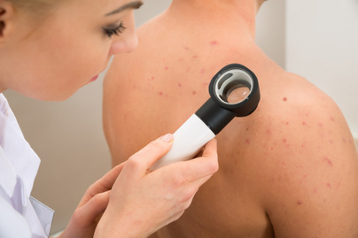 Felismered a melanomát? 6 képpár, amivel tesztelheted