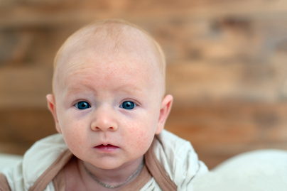 Az ekcéma első jelei a baba bőrén: sokan összekeverik más betegséggel