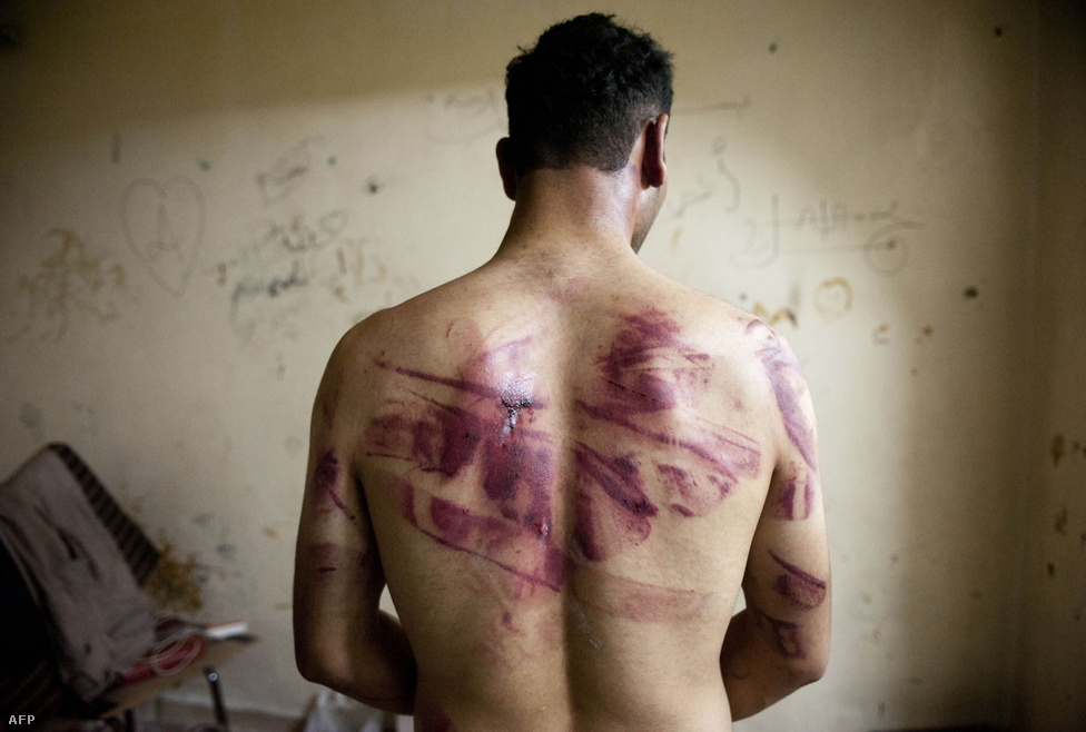 Egy férfi kínzás nyomait mutatja a hátán. Az ENSZ szakértői szerint Szíriában mindkét oldal elkövet emberiesség elleni és háborús bűncselekményeket, a kormányerők kínzást is.