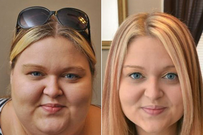Női arcok fogyás után - Fogyókúra | Femina - Fogyás fiatalabbnak tűnik