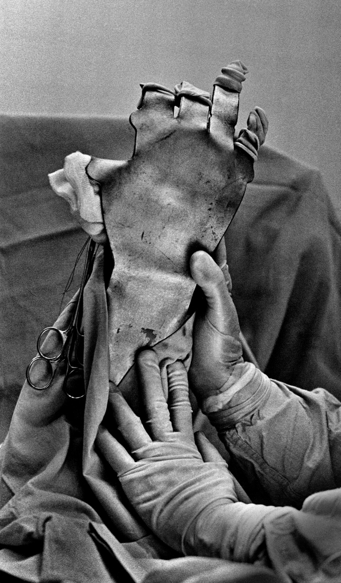 1981.06.10
                        Kézműtét a bp. Szobi utcai kórházban.Egy hentes munka közben törött üvegbe markolt.