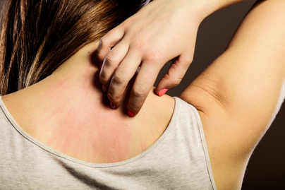 8 erős gyógynövény, ami megszünteti a bőrgyulladást: gyorsan csökkentik a viszketést is