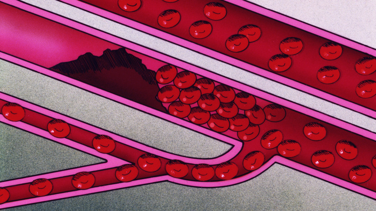 Majdnem minden szervben találtak vérrögöket egy koronavírusos beteg boncolásakor