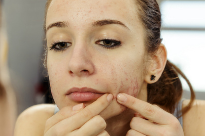 Milyen betegséget jeleznek az arc alsó részén megjelenő pattanások? Nem csak hormonális zavar okozhatja