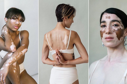 A rendellenesség szépségét mutatja meg a fotós: gyönyörű képeket készít vitiligós nőkről