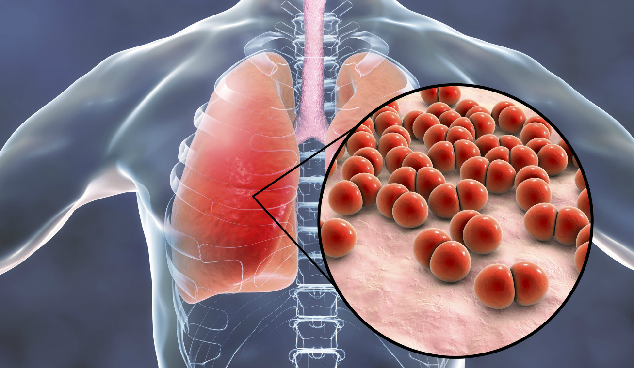 A tüdőfibrózis és tünetei - Fogyás tüdőgyulladás