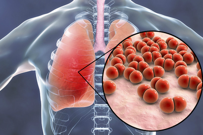A tüdőgyulladásnak súlyos szövődményei lehetnek: 65 év felett nem mindig szokványos tünetekkel jelentkezik