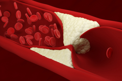 Növeli a szívinfarktus és az érelmeszesedés kockázatát: a koleszterinszint vizsgálata életmentő lehet