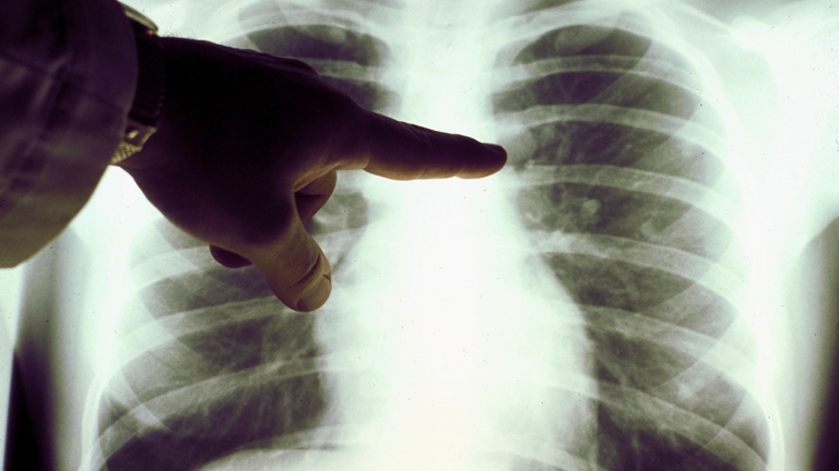 Félmillió krónikus tüdőbeteg is élhet Magyarországon