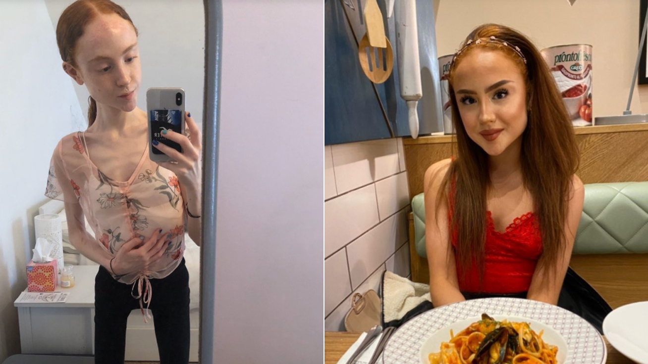 Megdöbbentő előtte-utána képek anorexiásokról
