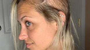 Ez a 26 éves nő 14 évig küzdött hajhullással, végül kopaszra borotválta magát
