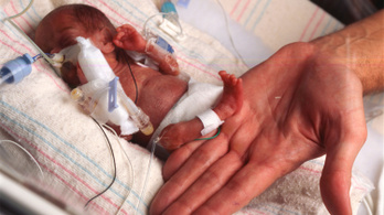 Halva született, elkapta a koronavírust, mégis életben maradt a brit csecsemő
