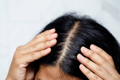 Hatásos lehet a férfias típusú hajhullás ellen a fűrészpálma? Hormonzavarok esetén is használják