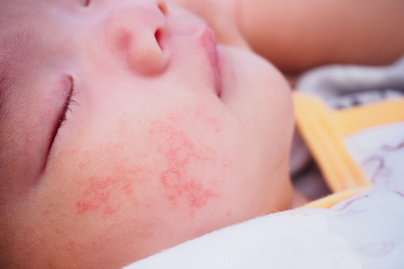 Az ételallergia jelei gyerekkorban: nem csak az arcon megjelenő vörös kiütéseket kell figyelni