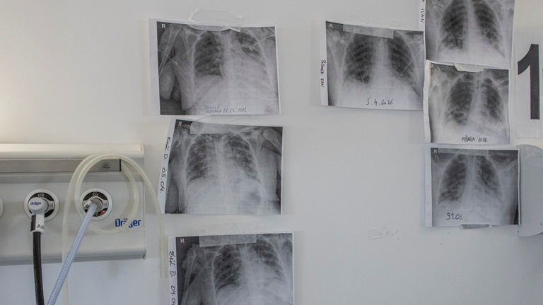 Covid–19 Szerbiában: fiatalok halnak meg kétoldali tüdőgyulladásban