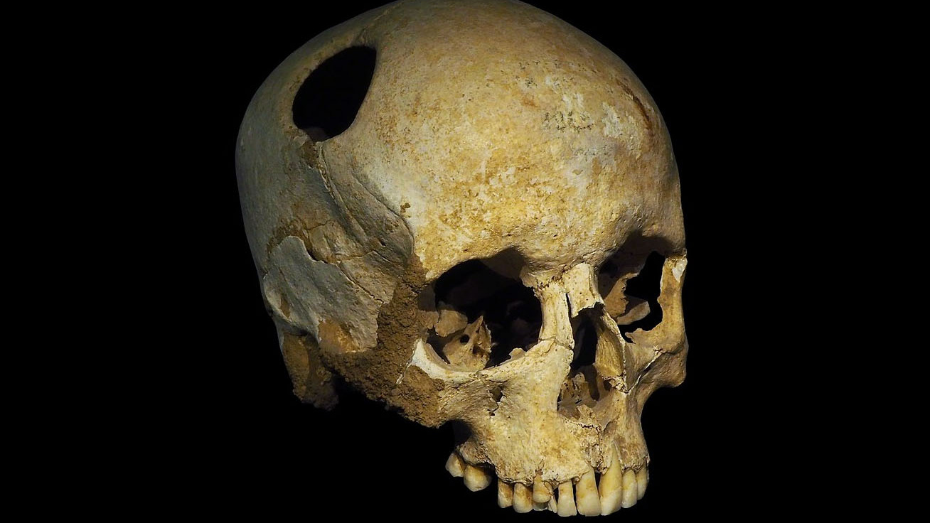 Miért fúrtak lyukat élő emberek koponyáján évezredeken keresztül? Rituálé vagy gyógymód is lehetett a tudósok szerint