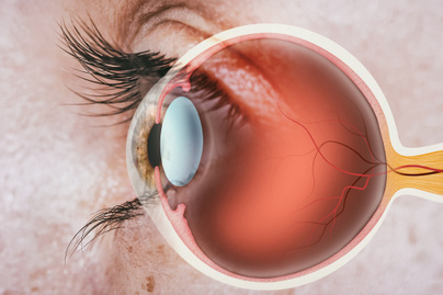 A cukorbetegség gyakori, súlyos szövődménye: akár vaksághoz is vezethet a diabéteszes retinopátia