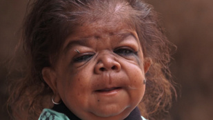 Titokzatos betegség miatt ragadt egy baba testében egy 26 éves indiai férfi
