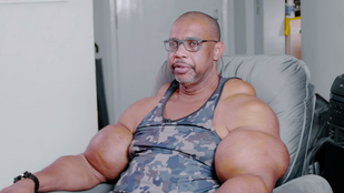 Ő az igazi Hulk: 71 centis bicepsze lett, mert olajjal injekciózta magát