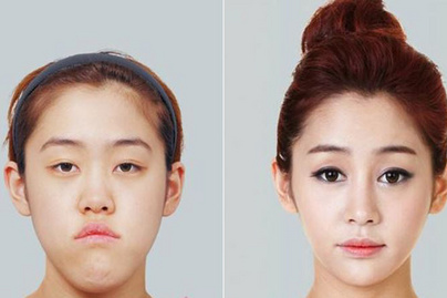 Mesterséges zsírpárna a szem alá: a koreai nők nagyon sok mindent bevállalnak a szépségért