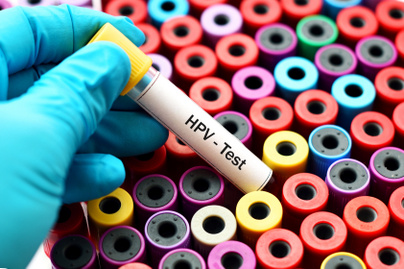 Miért okozhat rákot a HPV? Különböző testrészeken alakulhat ki a daganat