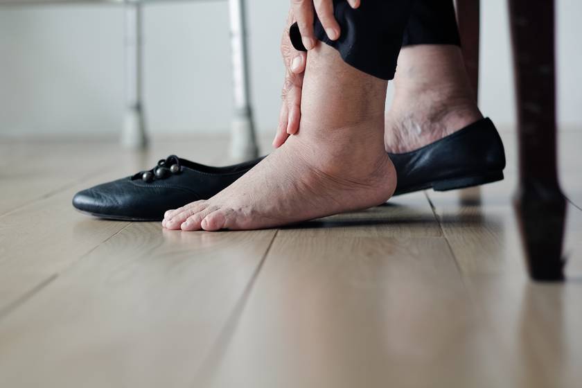 A kevés folyadékfogyasztás is lábdagadást okozhat: ez a 4 rendellenesség állhat a hátterében