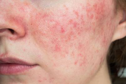 Bőrpírral, pattanásokkal, értágulatokkal jelentkezik a gyulladásos bőrbetegség - Nyáron különösen fontos odafigyelni rá
