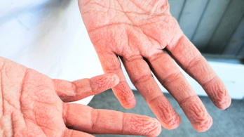 Miért áznak ráncossá az ujjaink? Betegséget is jelezhetnek