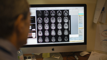 Új felfedezés hozhat áttörést az Alzheimer-kór kezelésében
