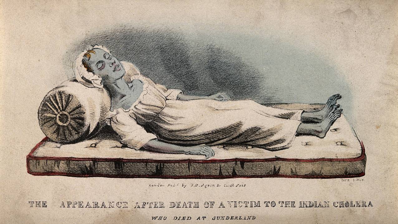 A dead victim of cholera at Sunderland in 1832. Coloured lit Wel
