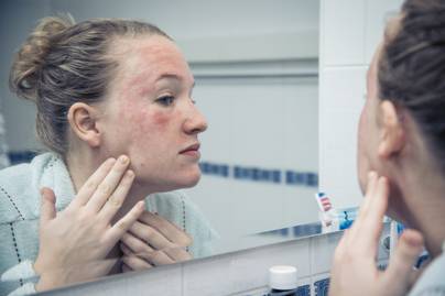 Duzzadt, kipirult bőr, sárgás, viszkető foltok: megtévesztő tünetekkel jelentkezhet a seborrheás dermatitisz